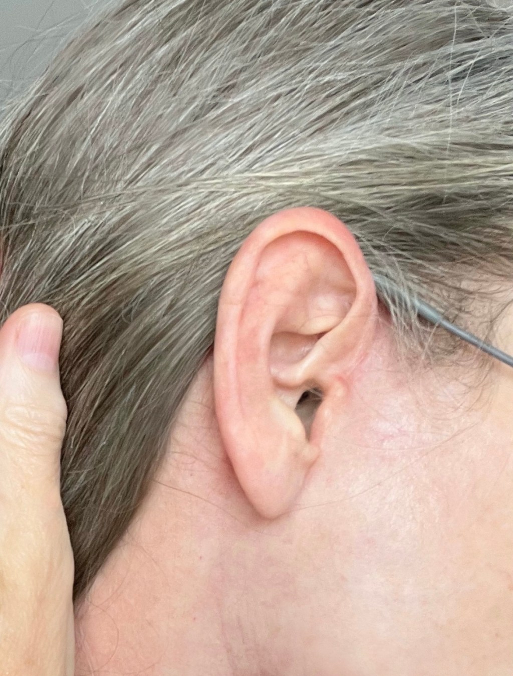 6 weeks post&nbsp;op