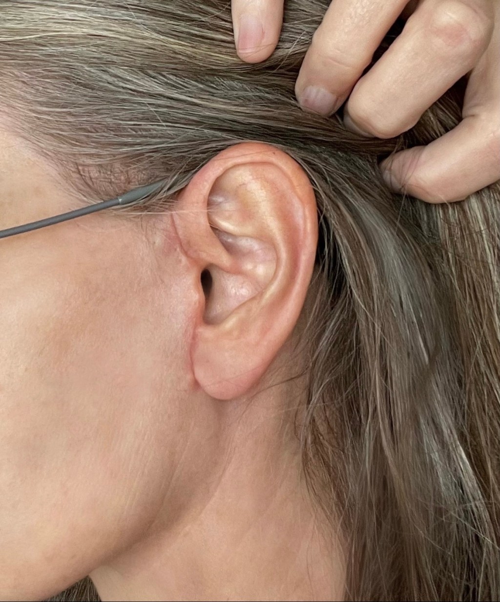 6 weeks post&nbsp;op