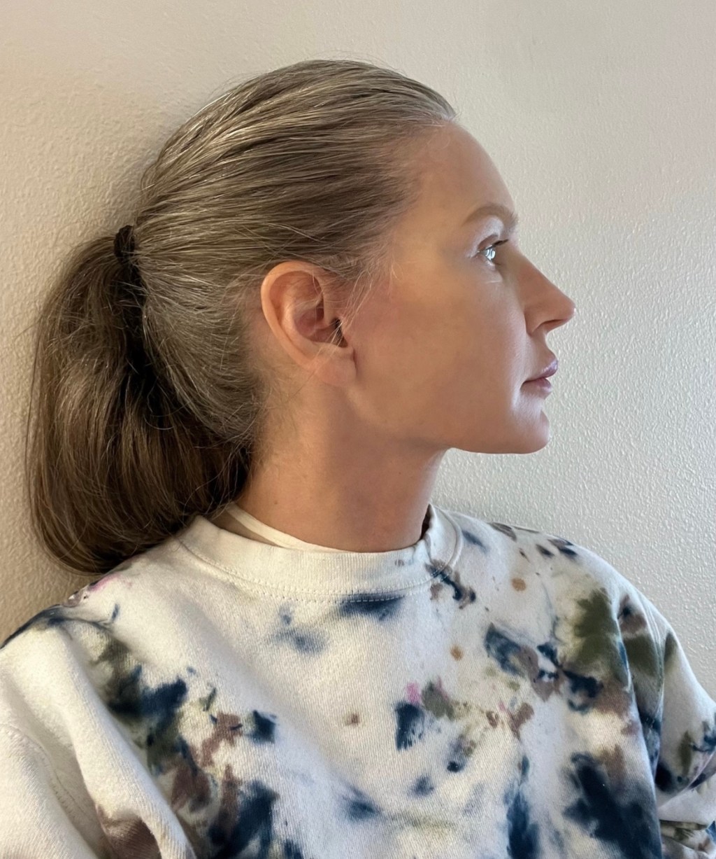 100 days post&nbsp;surgery