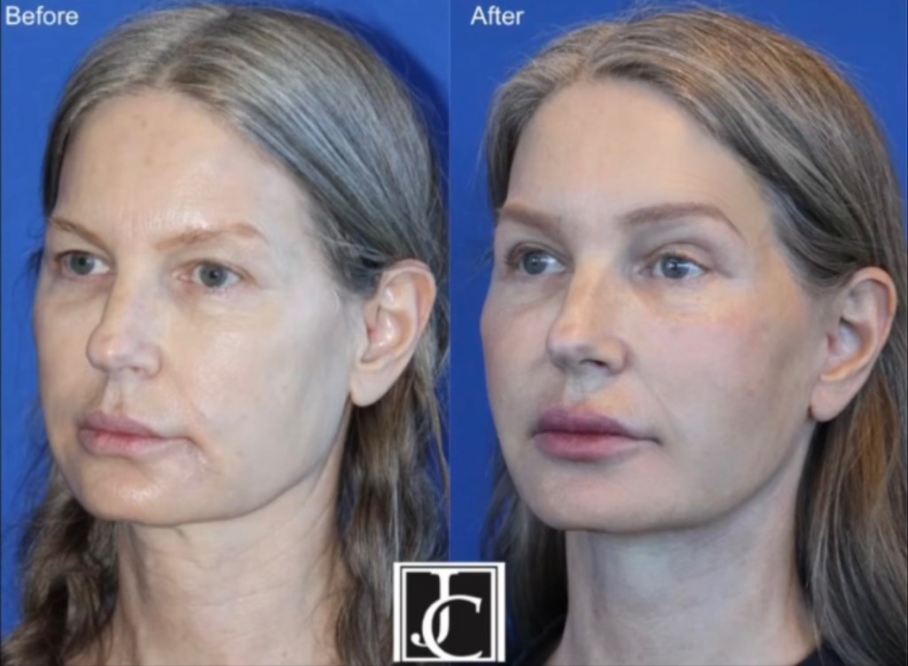 4 months post&nbsp;surgery