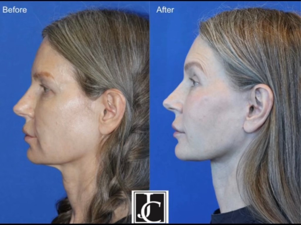 4 months post&nbsp;surgery