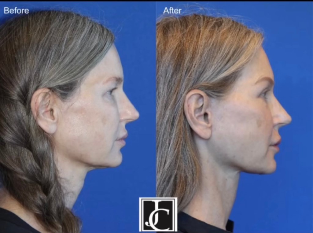 4 months post&nbsp;surgery